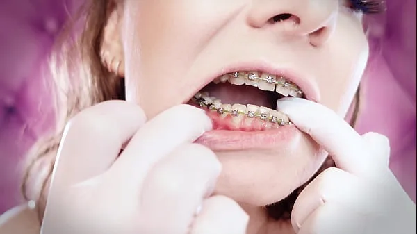 Grote ASMR: upgraded braces with chain-link rubber bands and nitrile gloves (Arya Grander totale buis
